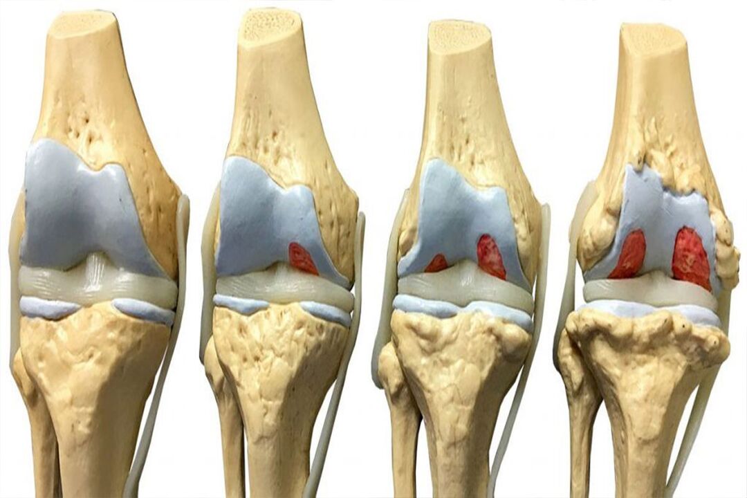 Etappe vun der Arthrosis Entwécklung