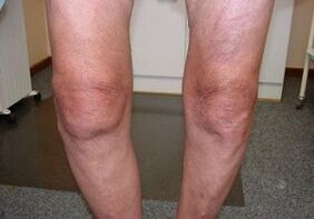 Wéi Dir Arthrosis vum Knéi Gelenk behandelt