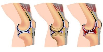 Zännbank vun der Entwécklung vu Arthrosis vum Knéi Gelenk