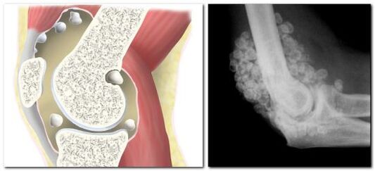 chondromatosis mat Péng am Hip Gelenk
